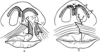 Схема 9.3. Этапы пластики верхней губы при односторонней врожденной расще­лине - student2.ru