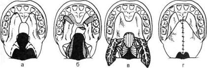Схема 9.3. Этапы пластики верхней губы при односторонней врожденной расще­лине - student2.ru