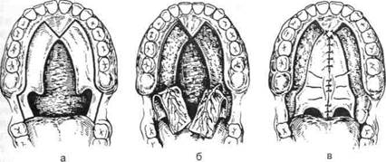 Схема 9.3. Этапы пластики верхней губы при односторонней врожденной расще­лине - student2.ru