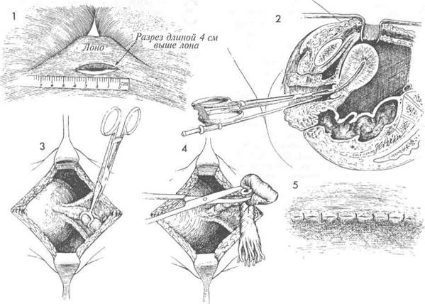 стерилизация по модифицированной методике irving - student2.ru