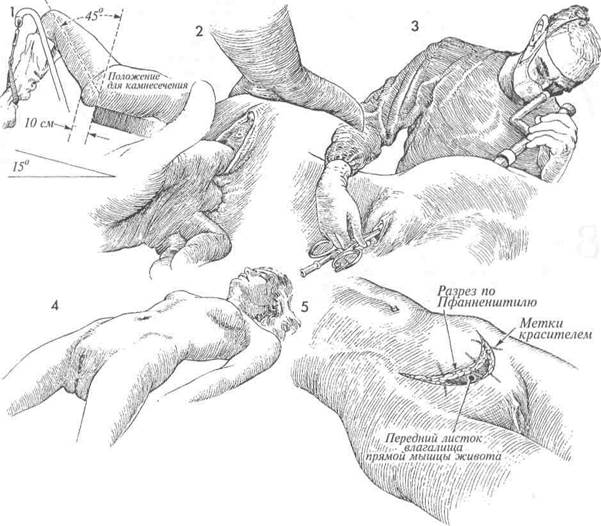 стерилизация по модифицированной методике irving - student2.ru