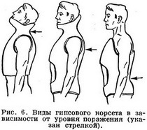 Техника наложения гипсовых повязок - student2.ru