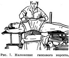 Техника наложения гипсовых повязок - student2.ru