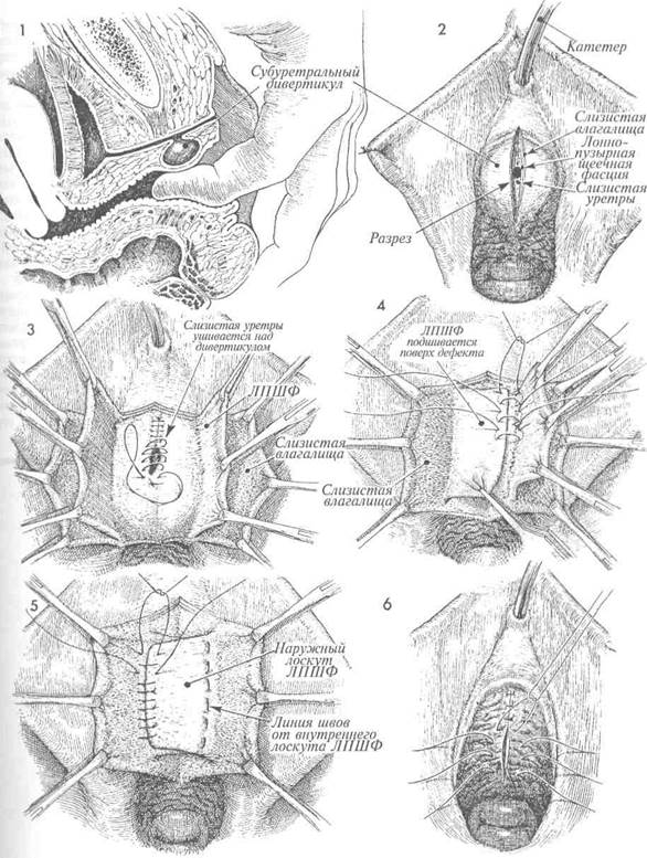 удаление субуретрального дивертикула методом двубортного закрытия дефекта - student2.ru