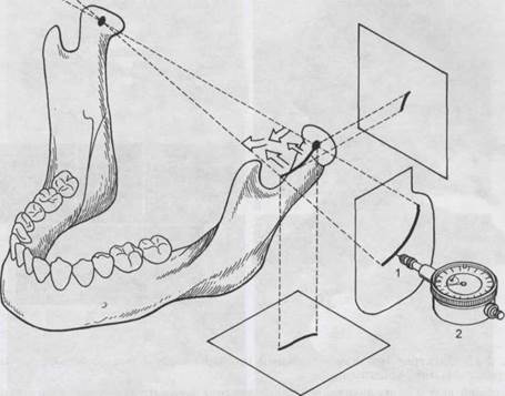 Внеротовая регистрация движений нижней челюсти (аксиография) - student2.ru
