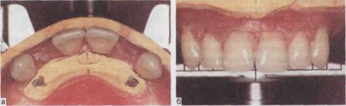 Восстановление окклюзии съемными протезами при полном отсутствии зубов на одной или обеих челюстях - student2.ru