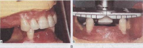 Восстановление окклюзии съемными протезами при полном отсутствии зубов на одной или обеих челюстях - student2.ru