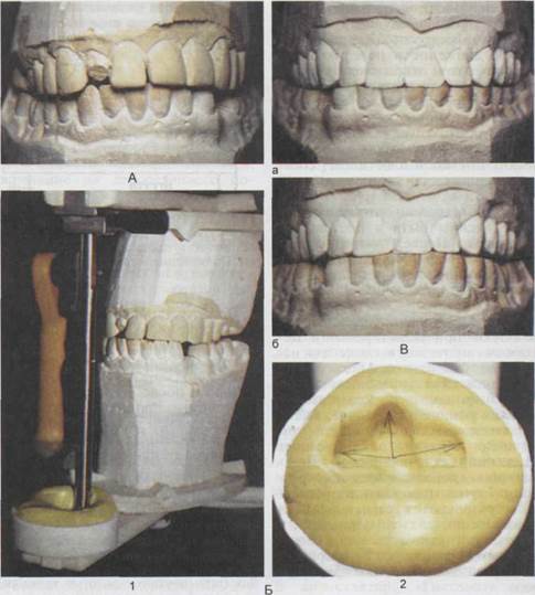 Восстановление передних зубов несъемными протезами с учетом регистрации резцовых путей - student2.ru