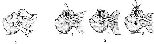 восстановление проходимости дыхательных путей - student2.ru
