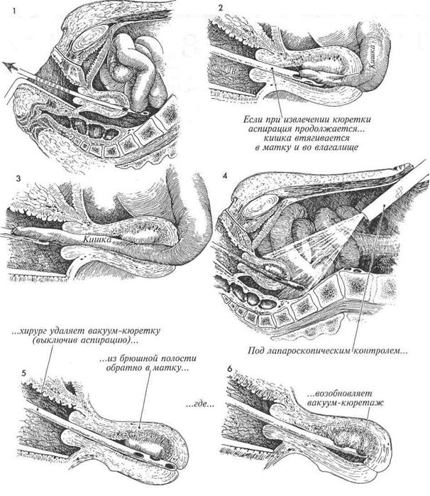 врачебная тактика при полной перфорации матки аспирационнои кюреткой или радионуклидным метростатом - student2.ru