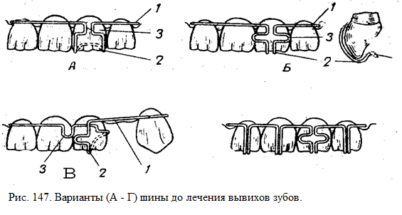 вывих зуба - student2.ru