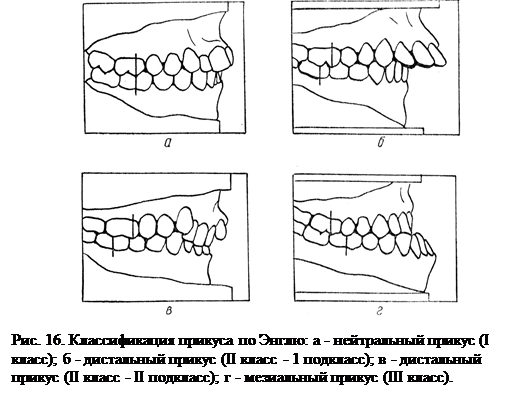 Энгелевский период классификаций аномалий зубочелюстной системы (классификация Angle, 1889) - student2.ru