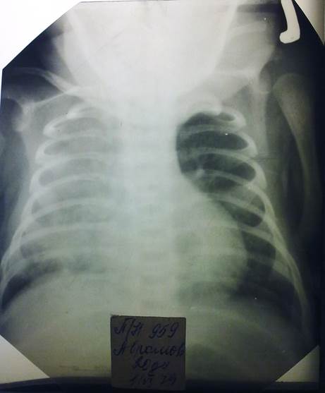 Рентгенография органов грудной полости прилагается - student2.ru