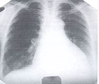Рентгенограмма грудной клетки в прямой проекции: - student2.ru