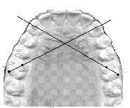 Измерение длины переднего отрезка зубных рядов. Дж. Коркхауз - student2.ru