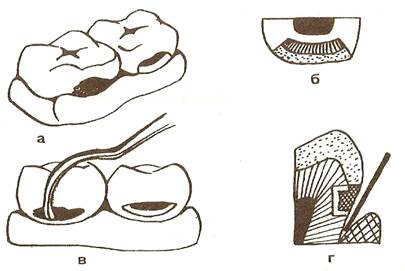Наложение постоянной пломбы - student2.ru
