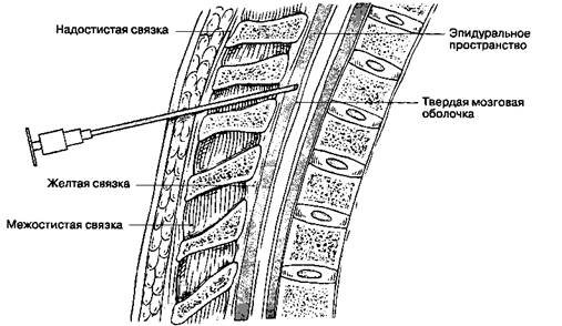 А. Идентификация эпидурального пространства - student2.ru