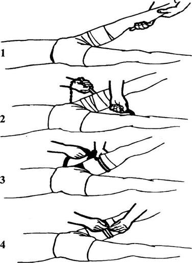 Алгоритм наложения жгута при ранении бедренной артерии левой ноги. - student2.ru