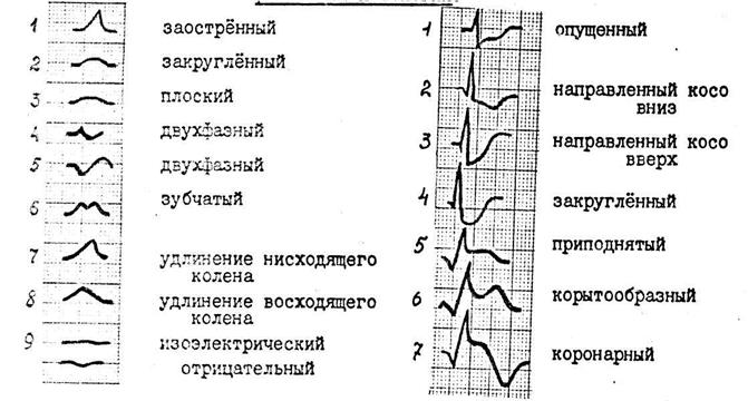 Анализ зубцов и интервалов - student2.ru