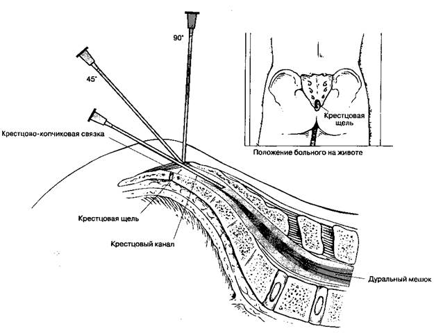 Анатомия каудальной анестезии - student2.ru