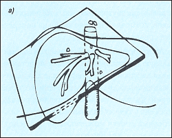Анатомия желчевыводящих протоков. Общий желчный проток. - student2.ru