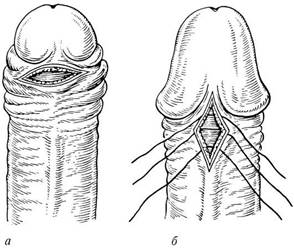 аномалии полового члена - student2.ru