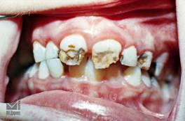 Аномалии развития и прорезывания зубов, изменения их цвета. - student2.ru