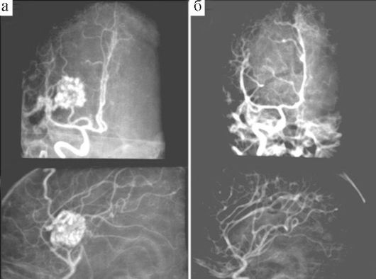 аномалии сосудов головного мозга - student2.ru
