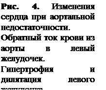 аортальная недостаточность (недостаточность клапанов аорты) - student2.ru