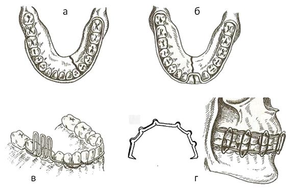 Аппараты и приспособления для фиксации и репозиции отломков челюстей при переломах. - student2.ru