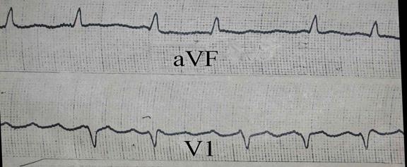 Аритмии с узким комплексом QRS - student2.ru