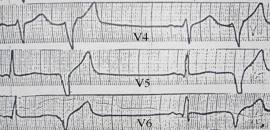 Аритмии с узким комплексом QRS - student2.ru