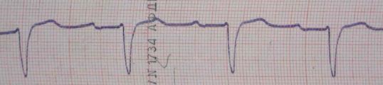 Аритмии с узким комплексом QRS - student2.ru