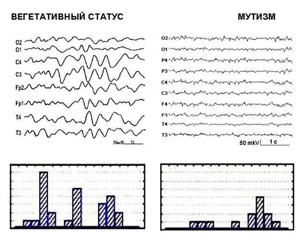 асимметрия когерентности ээг при посткоматозных бессознательных состояниях после тяжелой черепно-мозговой травмы - student2.ru