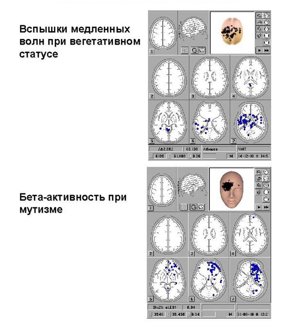 асимметрия когерентности ээг при посткоматозных бессознательных состояниях после тяжелой черепно-мозговой травмы - student2.ru