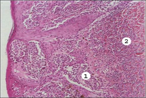 Атипичные разрастания эпидермиса. В воспалительном инфильтрате дермы много меланофагов - student2.ru