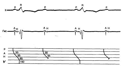 Атриовентрикулярная блокада первой степени - student2.ru