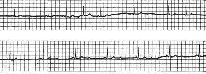 Атриовентрикулярная блокада первой степени - student2.ru