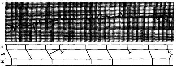 Атриовентрикулярная блокада первой степени - student2.ru