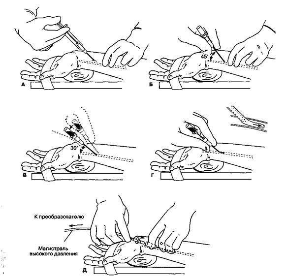 Б. Методика катетеризации лучевой артерии - student2.ru