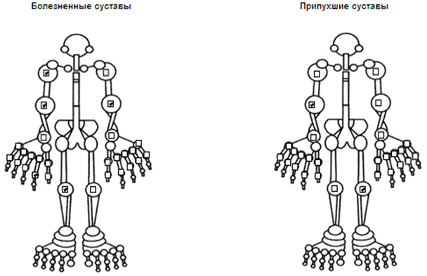 БА смешанного генеза (2 классификации смешали, см.ниже) может атопическая и инфекционно завис.?, тяжелое течение, стероидозавис., ремиссия. ДН 1. а то и 2. почему?? - student2.ru