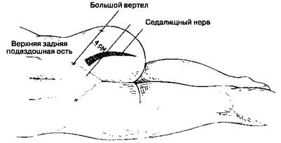 Блокада нервов в подколенной ямке - student2.ru