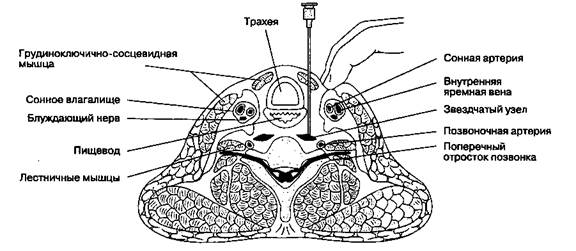 Блокада шейных и верхнегрудных симпатических узлов (блокада звездчатого узла) - student2.ru