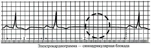 Блокады – нарушения проводимости - student2.ru