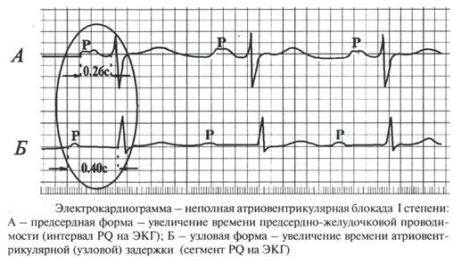 Блокады – нарушения проводимости - student2.ru