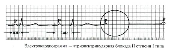 Блокады – нарушения проводимости - student2.ru