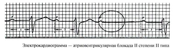 Блокады – нарушения проводимости - student2.ru