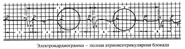 Блокады – нарушения проводимости - student2.ru