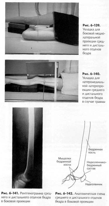 боковая - медиолатеральная или латеромедиальная проекция: бедренная кость - student2.ru