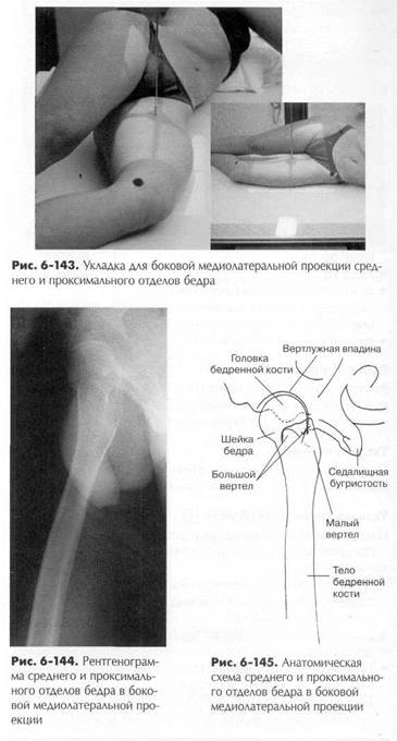 боковая - медиолатеральная или латеромедиальная проекция: бедренная кость - student2.ru